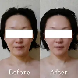 小顔矯正コースしっかり65分