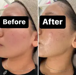 💙花粉やマスクによる肌荒れ改善【クリスティーナ 乳酸菌ピーリング アンストレス】💙