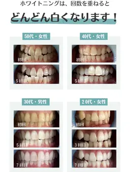 【ミニモ限定】メディアで話題♪セルフホワイトニング✨プレミアムコース✨8分x2【すぐ予約対象外】