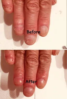 深爪改善(ワンカラー)