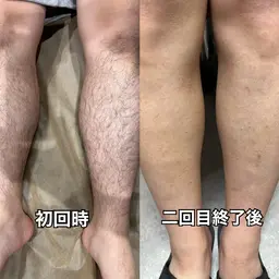 初回限定　メンズ　下半身脱毛（VIO込み）通常都度払い11000円→4400円