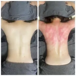 ミニモ限定カッピング痩身全身30分➕ヒートマット付き