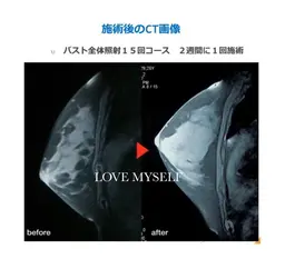 光バスト(フォト)美背中マッサージ＋お胸