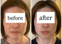 人気No.1🍀【美容鍼×頭蓋骨コルギヘッドスパ】小顔/眼精疲労/脳疲労/むくみ/たるみ/即効性◎