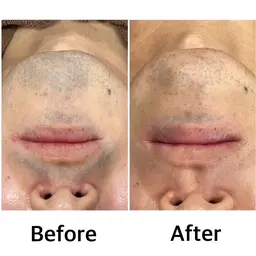 【新規男性/人気NO.1/短期間でカミソリいらず】ひげ光脱毛体験¥2200