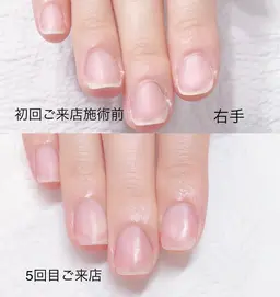 《ハンド短期集中深爪矯正アクリル使用》施術合計4回(ご来店目安3週に1回)オフ込