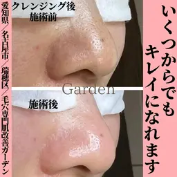 毛穴エクストラクション 毛穴改善コース 🍀ミニモ限定価格🤫🍀 施術後皆さん鼻をご自身で触られてとても感動されます。