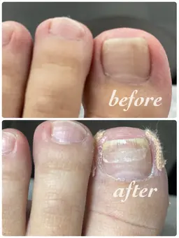 BSスパンゲ巻爪ケア🦶1本