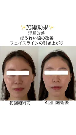 全身整体+小顔矯正+美容鍼