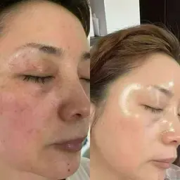 💝スピダイヤで水光肌へ肌質改善💝60分　塗るポテンツアーで整形級に変身！韓国女優のようなキュッと引き締まった水光肌へ