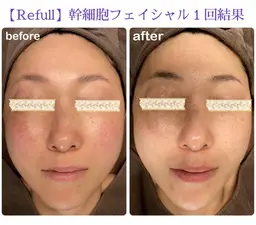 《回数券お持ちの方限定》肌力UP✨レストセルフェイシャル(80分)
