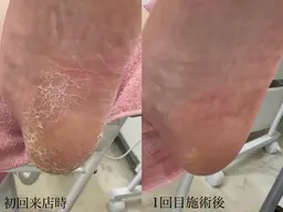 本格足裏角質ケア