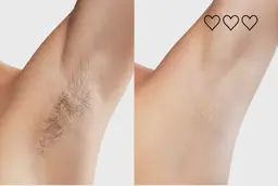 【男性限定】最先端脱毛機械！剛毛脇毛×ふくらはぎ脱毛×腕脱毛　気になる部位3部位まとめてケア