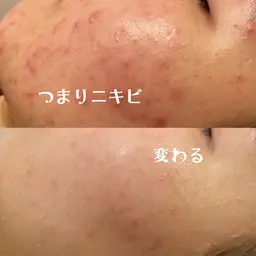 【口コミ限定❤️】ロウパック&Yurumiヘッドマッサージで自律神経が整う❕✨