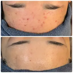 【ニキビ・ニキビ跡に!】次世代ハーブピーリングで本気の肌改善✨すっぴんでも自信の持てるお肌へ♡剥離なし、ダウンタイムなし