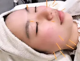 人気No. 2👑美容鍼➕潤肌パック