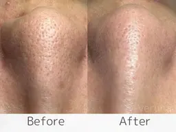 【毛穴改善】剥離ハーブピーリング＆顔リンパマッサージ¥22000→