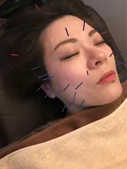 【春キャン🌸】美容鍼初めての方に🍃小顔・美肌・むくみに！美容鍼＋ヘッドスパ＋リンパケア｜初回限定