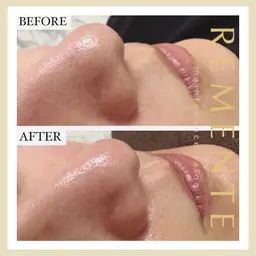 【✨口コミ記載の方体験半額！✨】★期間限定★毛穴の汚れを一掃✨ハイドラフェイシャル（毛穴洗浄）‼️ニキビや黒ずみに効果