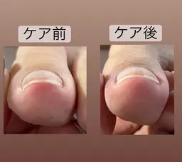 巻き爪ケア、陥入爪ケア、剥離ケア(指1本につき)