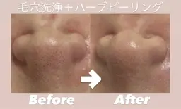 🌟ご新規様限定🌟【毛穴洗浄＋ハーブピーリング】　黒ずみ/開き毛穴汚れスッキリ！ツルツルで触りたくなるお肌へ🪞✨
