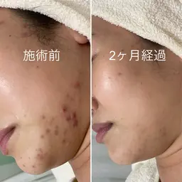 【繰り返す深刻ニキビから解放】ニキビケアフェイシャル初回¥24,200→¥12,000