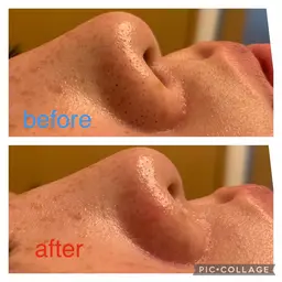 ✨毛穴集中フェイシャル✨　60分