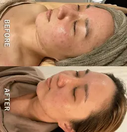 【初めての方はこちら】REVIハーブピーリング(全顔)