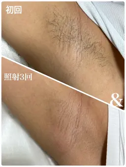 【やるしかないよね?】ワキ脱毛 初回 ¥500