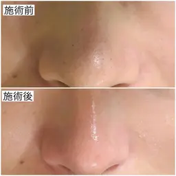 【特別価格】毛穴洗浄コース