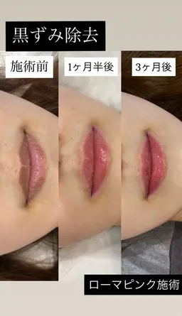 🩷人気沸騰中のローマピンク🩷まずはカウンセリングにどうぞ🫧