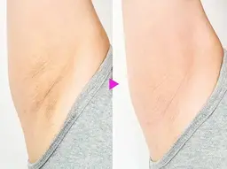 【黒ずみ美白脱毛】脇プラ脱毛2回分