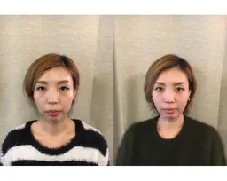 【✨人気No.1✨】美容鍼(プレミアムコース)＊ご新規様限定＊🉐初回カウンセリング料無料