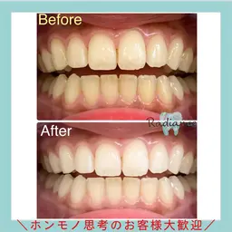 【都度払い】ライトコース8分3回照射