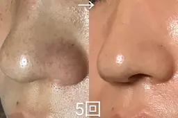 【モニター】水素ピーリング＋プラズマニードル＋エクソソムフェイシャル