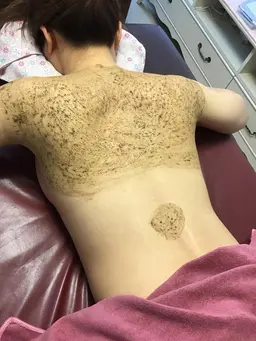 エルモサハーブトリートメント　背中のニギビ撃退！！『上部または下部』3g  通常33000円→ミニモ価格16500円