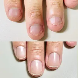 深爪矯正　幼い頃からの噛み癖やむしり癖による深爪を縦長爪へ。オイル1本プレゼント