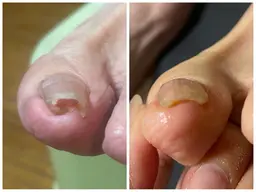 【巻き爪】親指１本