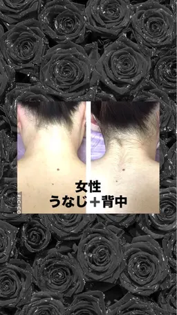 うなじ背中脱毛