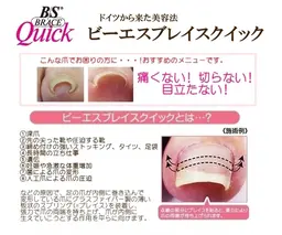夏に向けて今からいかがですか?(B/Sブレイス巻き爪矯正)練習モデル様募集🫧 片足🦶🏻💛