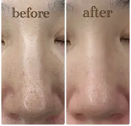 毛穴撲滅メニュー💙肌負担なし!!ピーリング&毛穴洗浄🫧超音波で毛穴の奥の汚れまで掻き出してむき卵肌に🥚