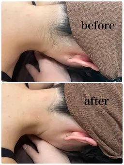 うなじ脱毛♡うなじ美人へ✨🩷