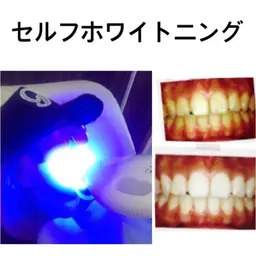 セルフホワイトニング(初回限定)