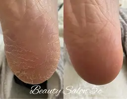 フット角質ケア