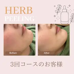【大人気✨】ダウンタイムなし！育肌ハーブピーリング🌿ツヤ肌/トーンアップ✨