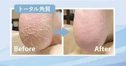 【足裏タコケア】足裏にできたゴワゴワ🌀角質もスベスベの足裏に✨🔅