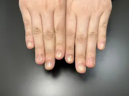 深爪矯正（ホームケア用オイル込）