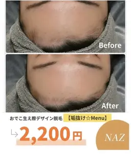 【新生活応援✨垢抜けメニュー】おでこ美形デザイン脱毛