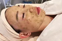 【☆肌質改善☆】クレンジング+毛穴洗浄+OHLハーブピーリング+パック60分　¥15000→¥8000