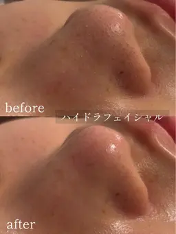 【4月末迄ご予約限定】大人気☆ハイドラフェイシャル/徹底毛穴洗浄でメイクノリアップ◎メンズもOK！※ご来店日が4月中限定